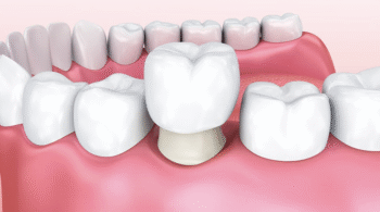 Case Study on Clinical Evaluation of Prosthodontic products